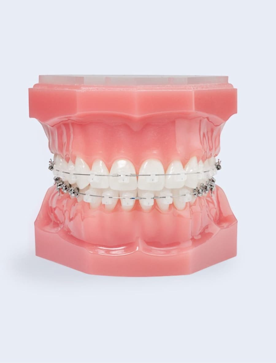 metal braces on plastic model