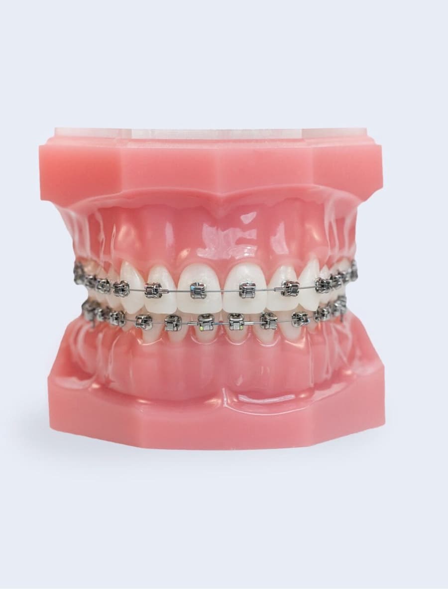 metal braces on plastic model