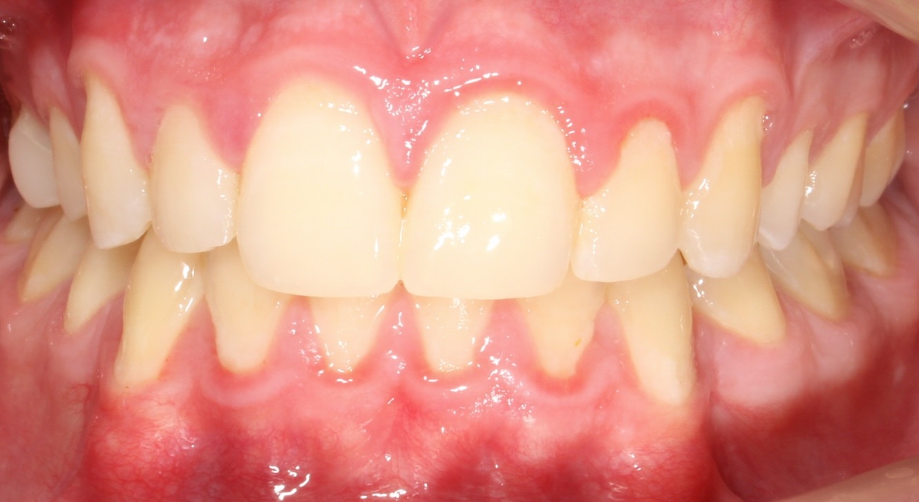 after Image