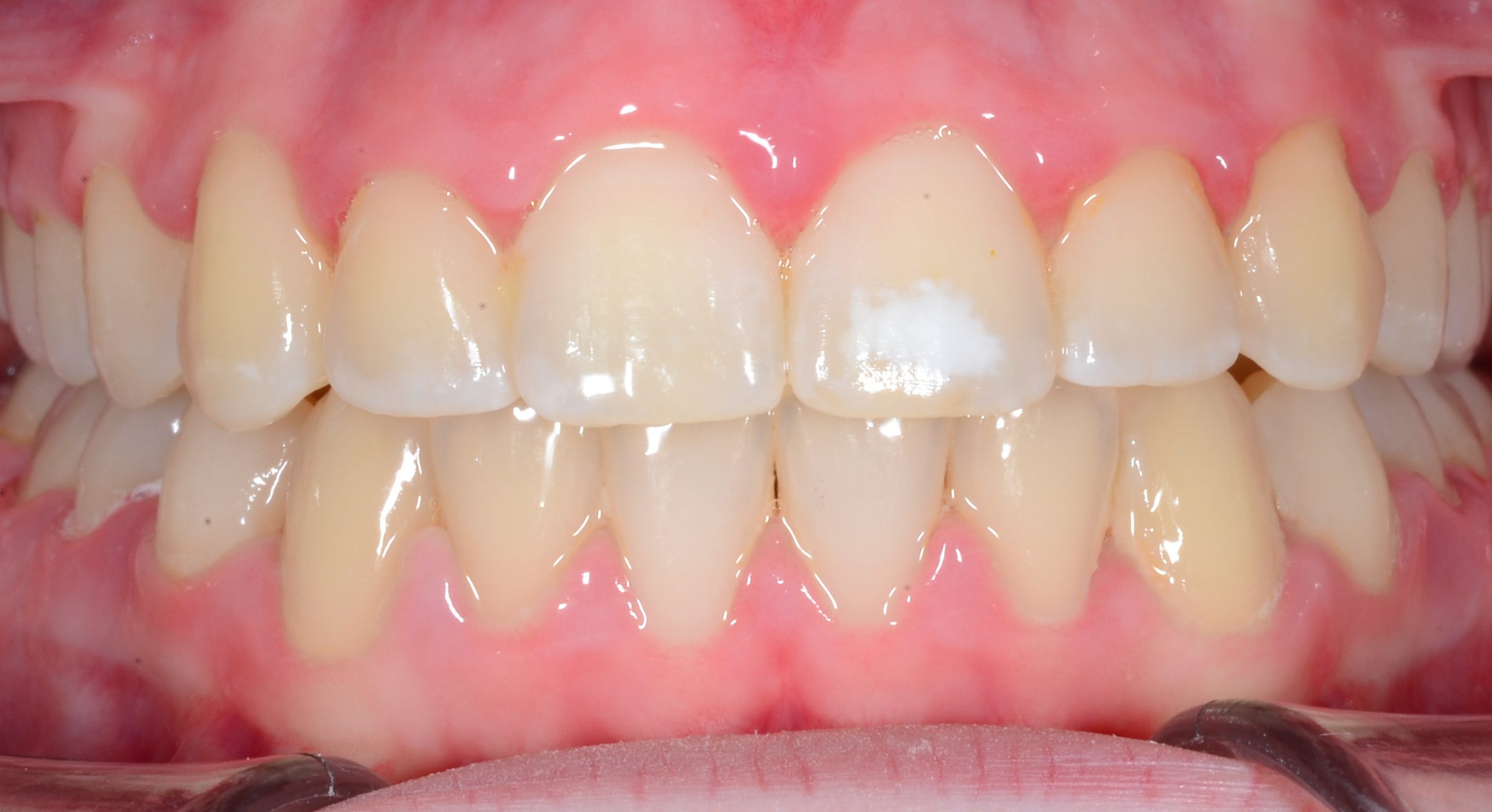 after Image