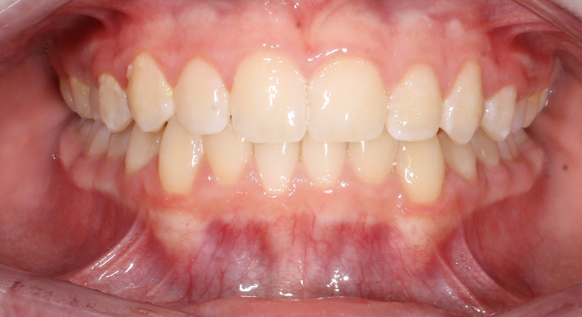 after Image