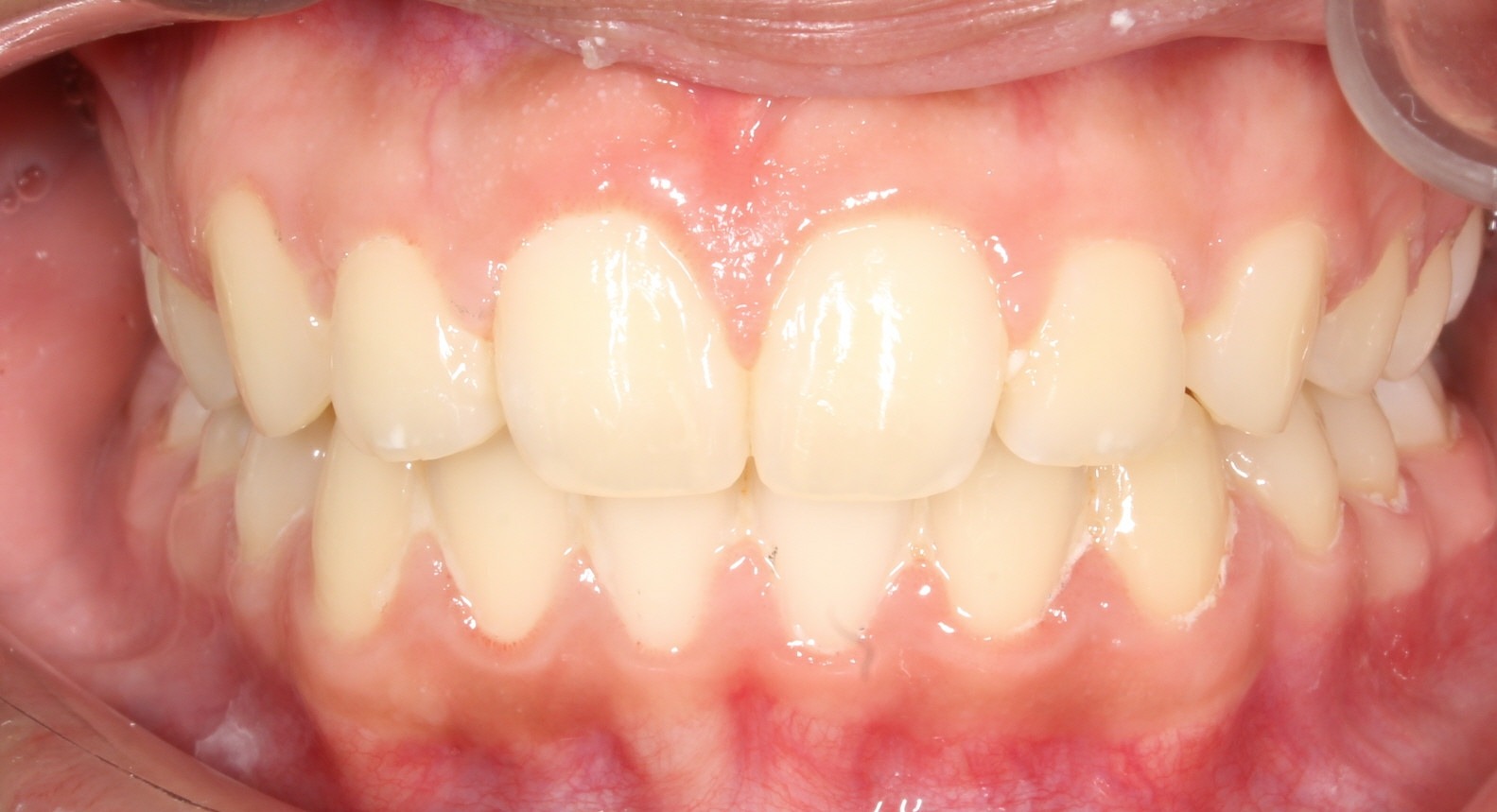 after Image