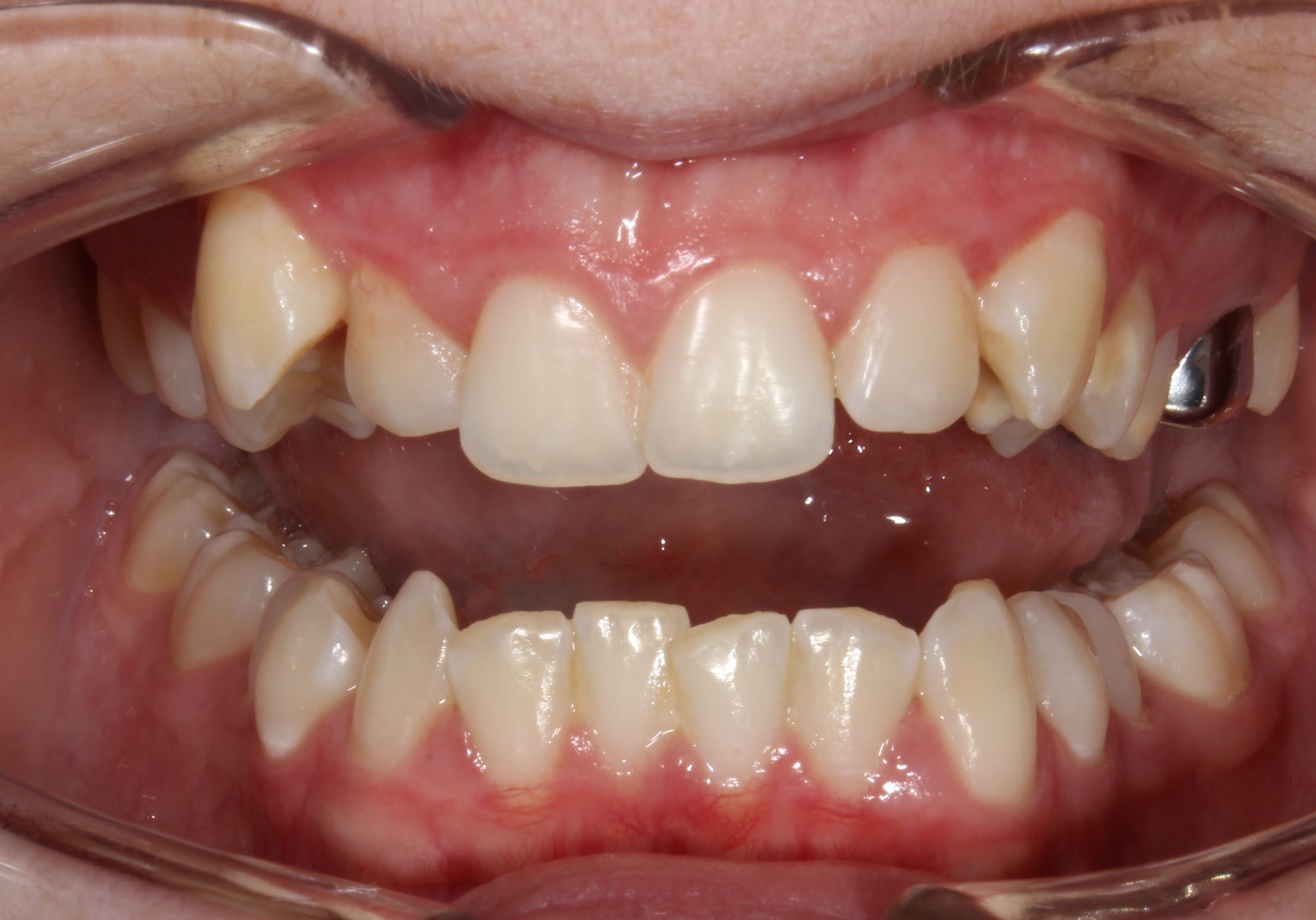 before Image