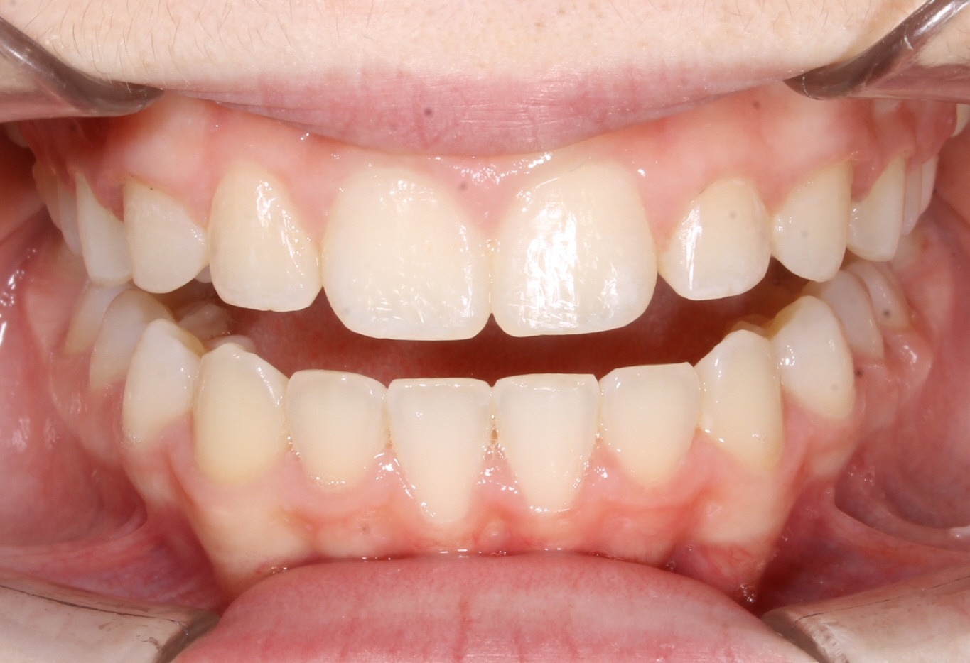 after Image