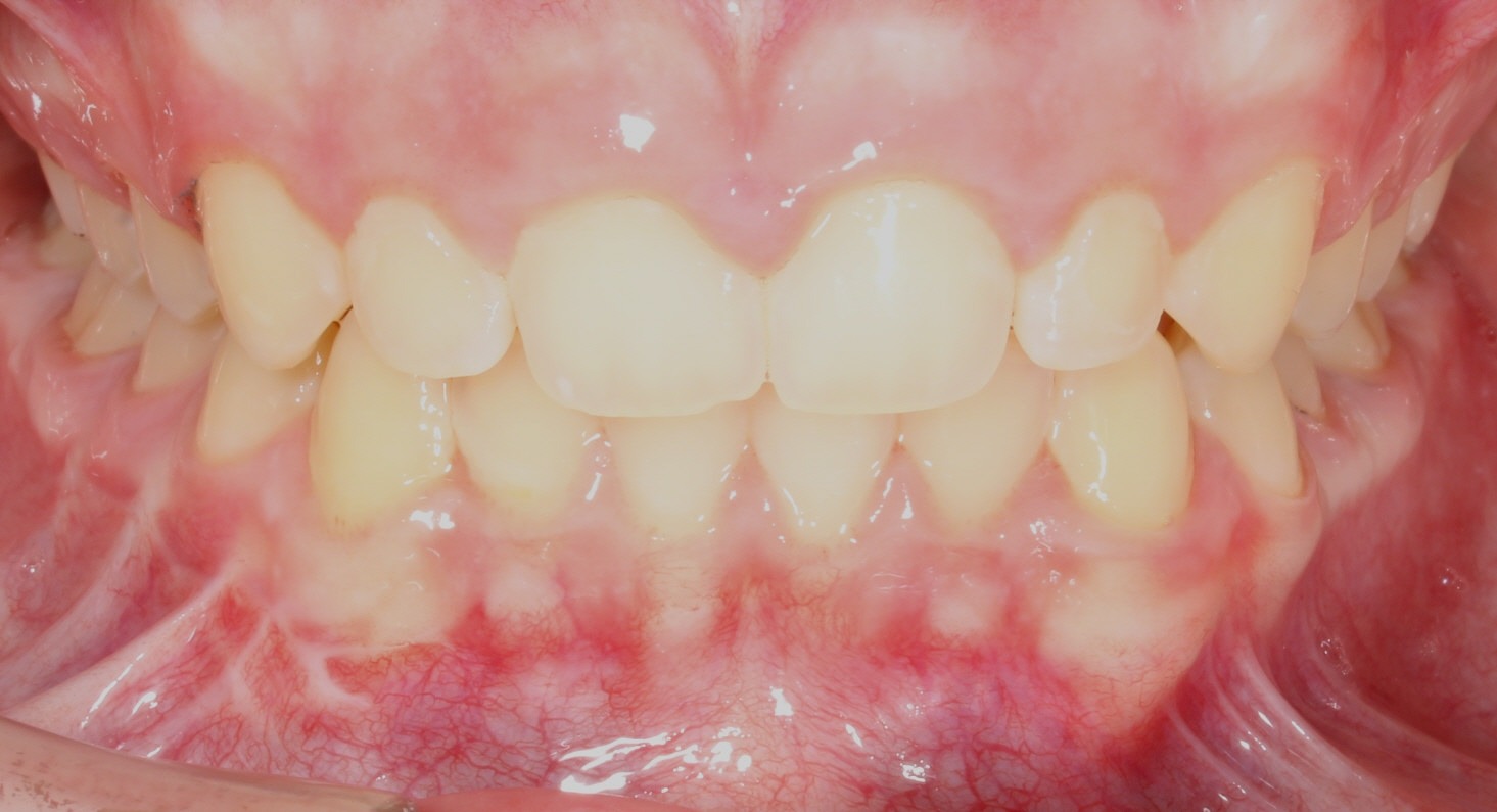 after Image