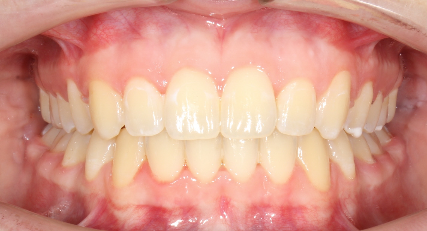 after Image