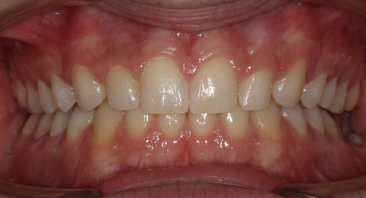 after Image