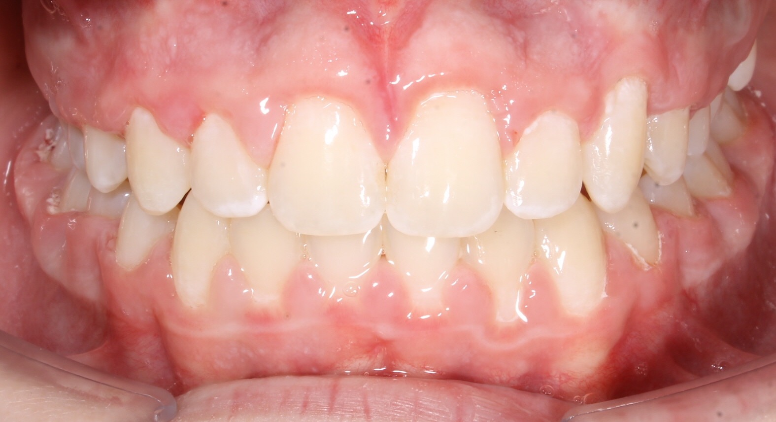 after Image