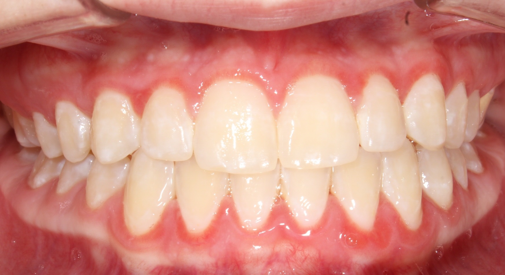 after Image