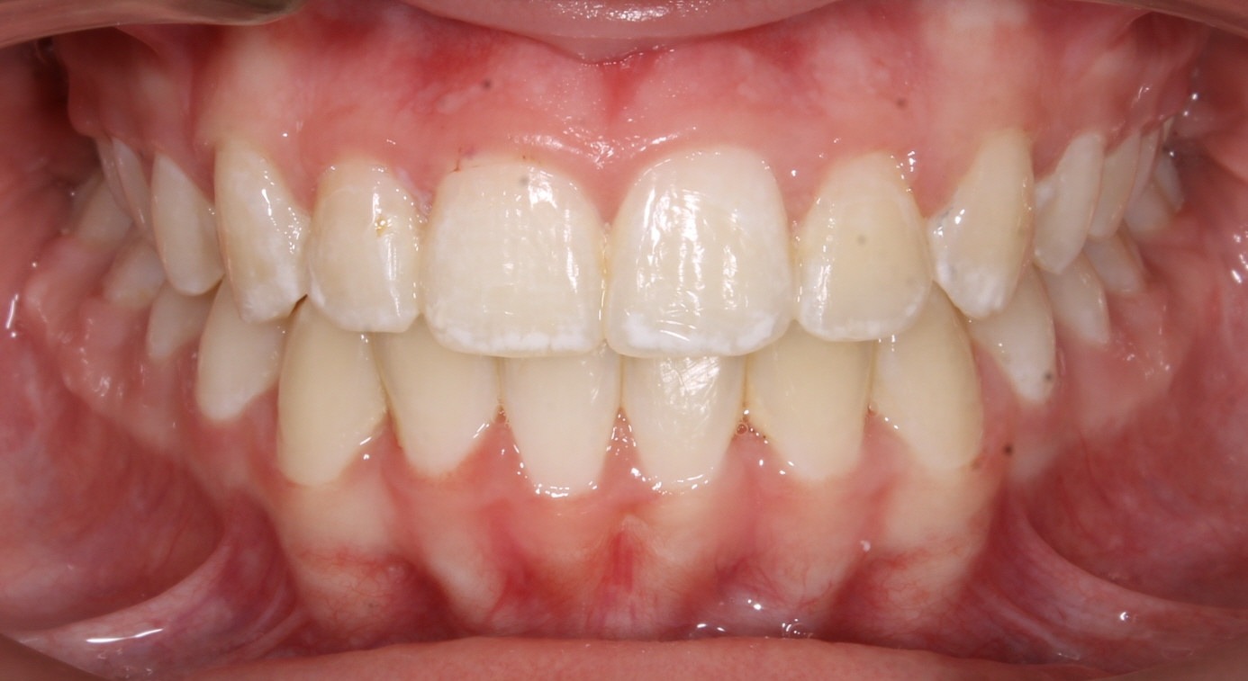 after Image
